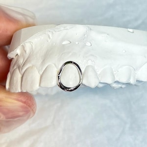 May include: A close-up of a white dental mould with a silver ring-shaped dental retainer placed between two front teeth.