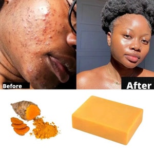 Turmeric Soap Cleaner - Great For Dark Spots, Eczema, Scars, Acne and etc (Buy 5 or more Get FREE SHIPPING )