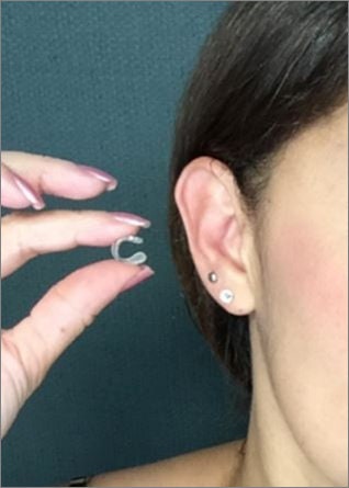Gold keloid pressure earring • Keloid cartilage earring • Keloid conch -  Hand Stamped Trinkets