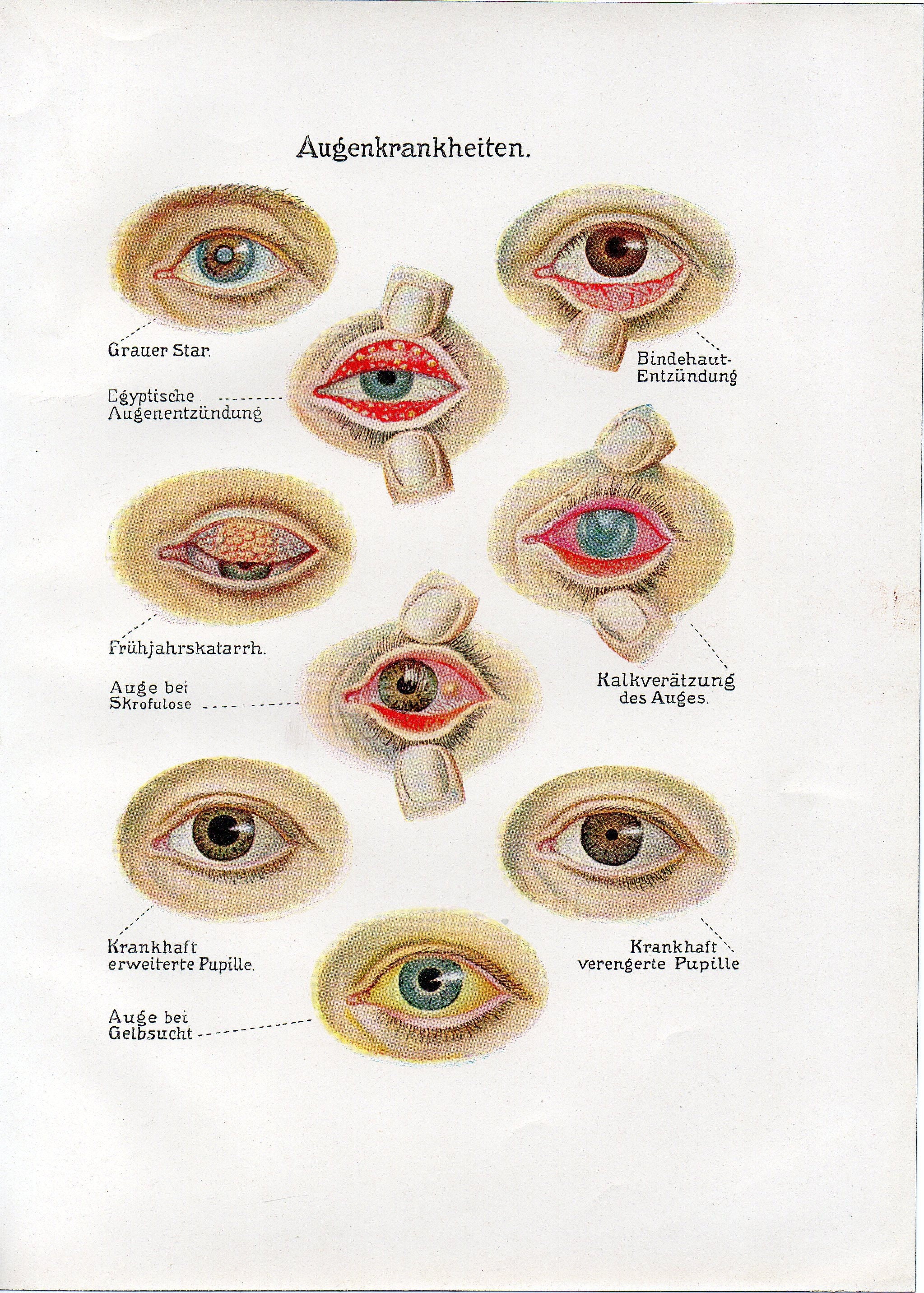 Eye Disease Chart