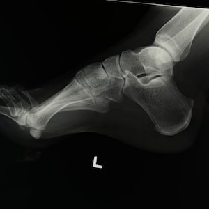 Foot X-Ray