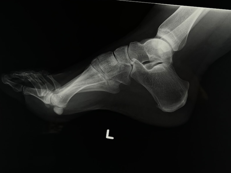 Foot X-Ray