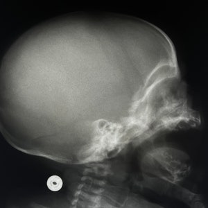 Profile X-Ray