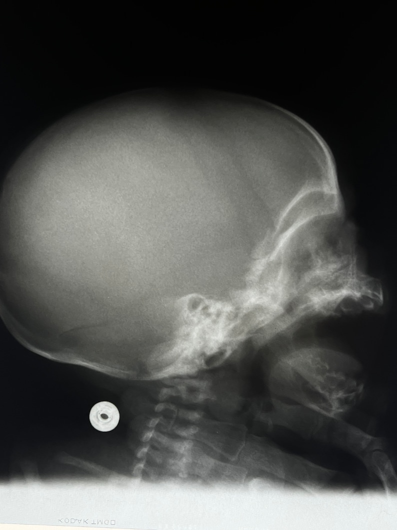 Profile X-Ray