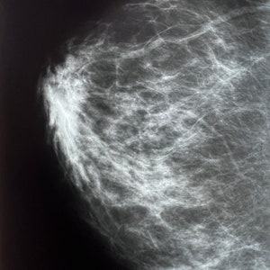 Breast X-Ray