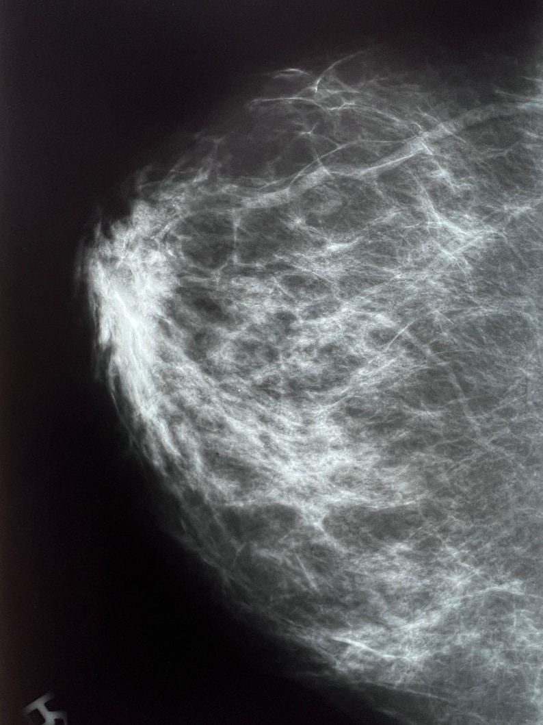 Breast X-Ray