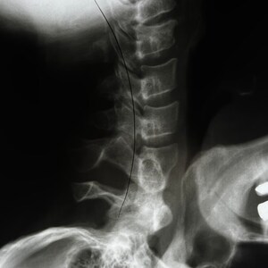 Neck X-Ray