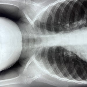 Child X-Ray