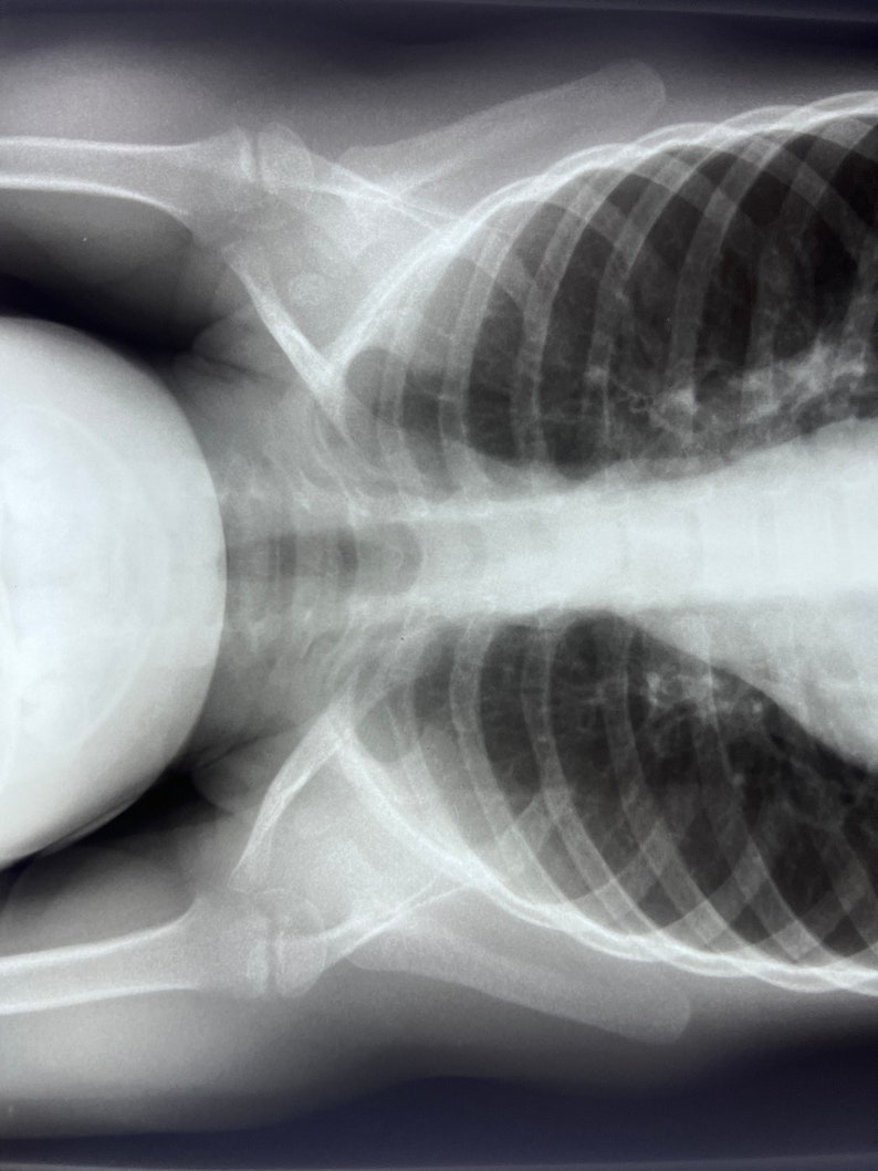 Child X-Ray