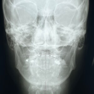 Head X-Ray