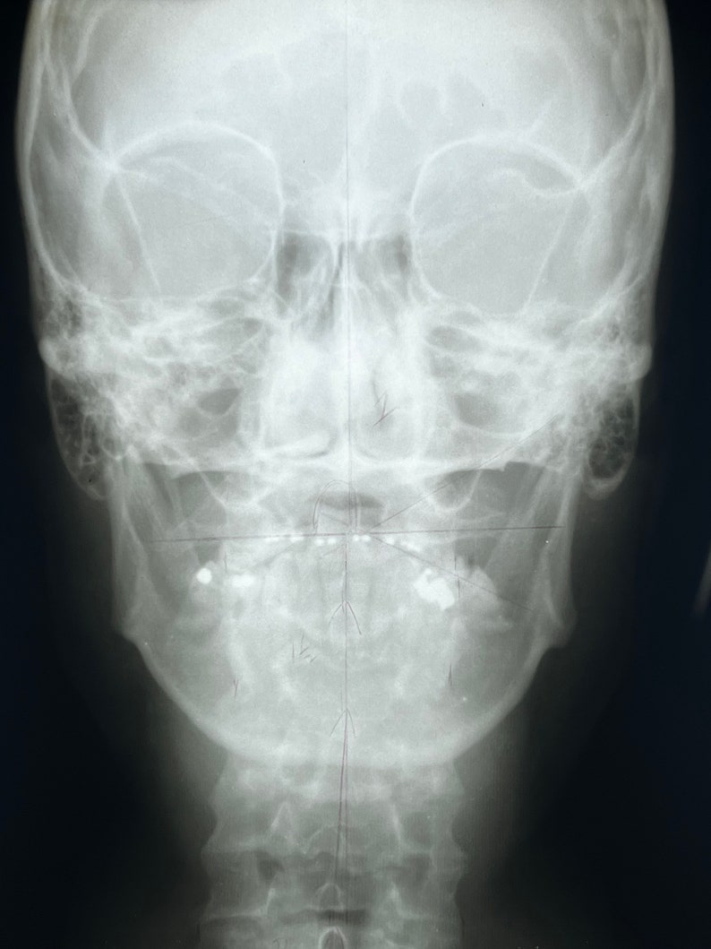 Head X-Ray