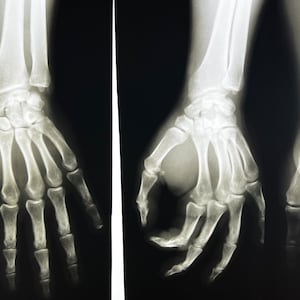 Hand X-Ray