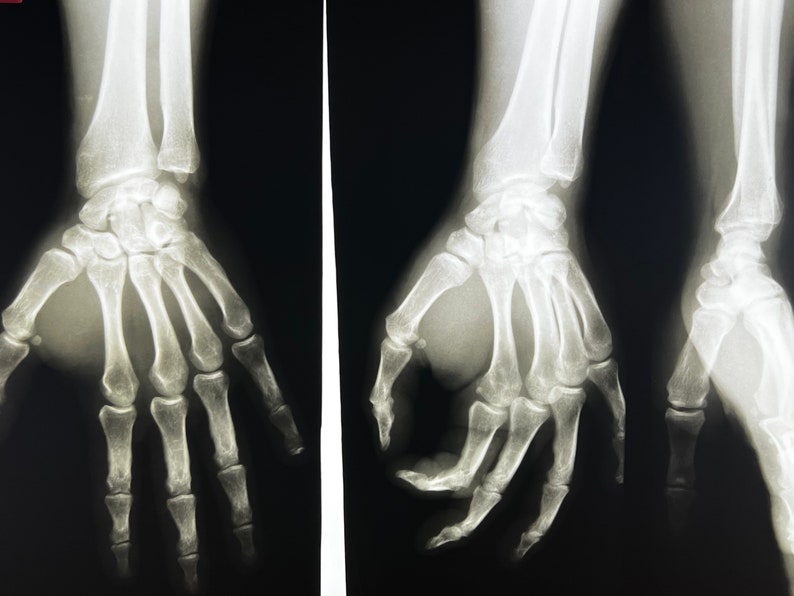 Hand X-Ray