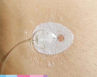 Medtronic Infusion Set Protective Transparent Patches - Diabetic Patches - 30 patches