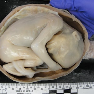 Cutaway View Human Fetus in Utero, 20 Week Old STL, Rare High Resolution Fetal Baby 3D Scan
