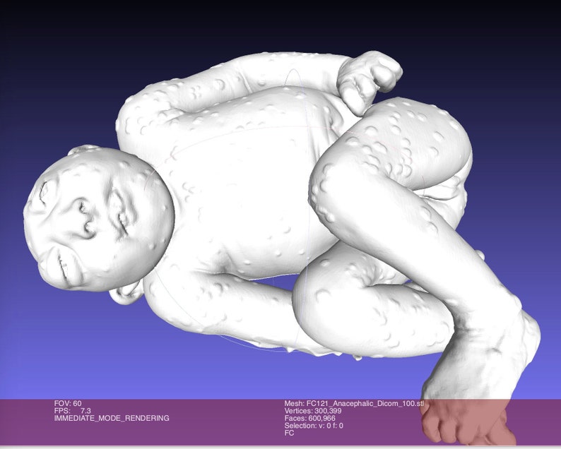 Anacephalic Rare High Resolution 3D Scan Human Fetus 36 Weeks Old Congenital Defect ANACEPHALY image 2