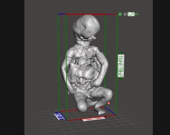 CYCLOPS Rare High Resolution 3D Scan Human Fetus 36 Weeks Old Congenital Defect AUTOPSIED
