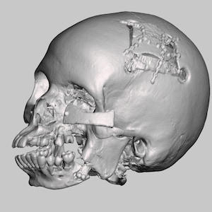May include: A 3D model of a human skull with a surgical plate and screws on the right side of the head. The skull is missing a portion of the bone on the top of the head.