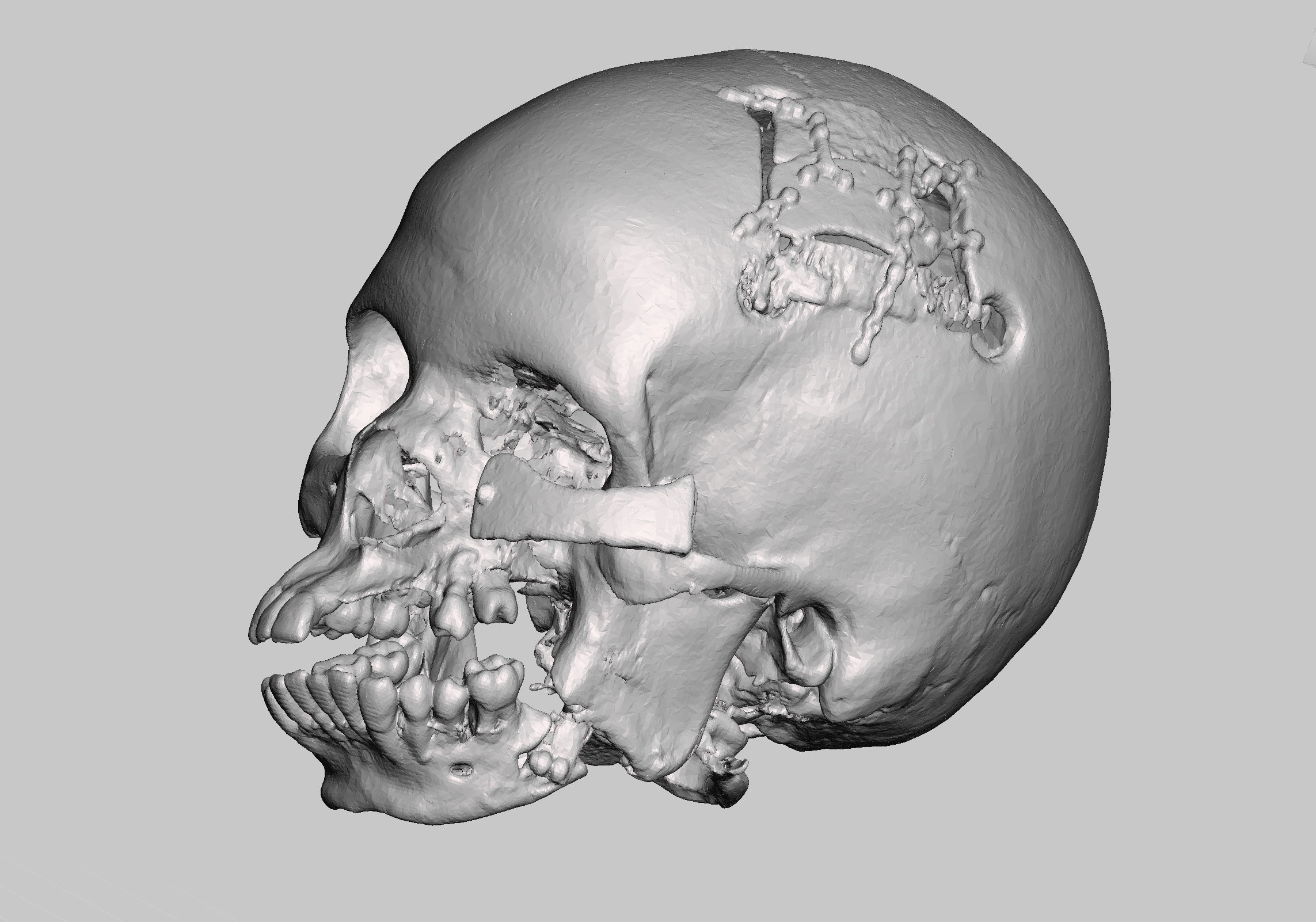 Male African American Skull, Horrific Car Accident, (modern Human