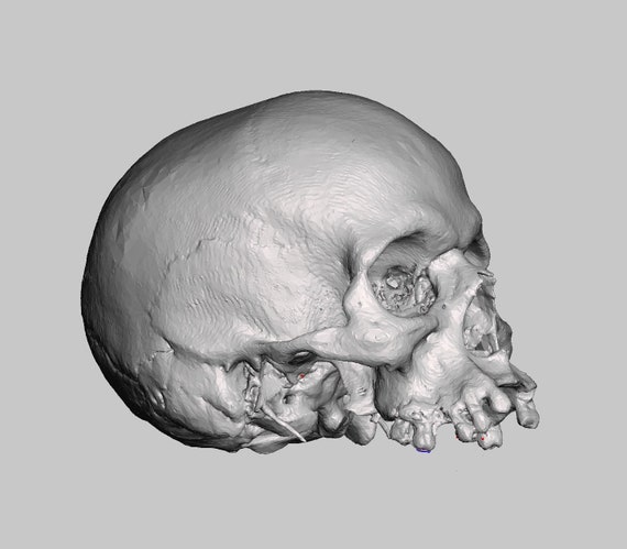 African American Male Unautopsied Skull (modern Human CT SCAN