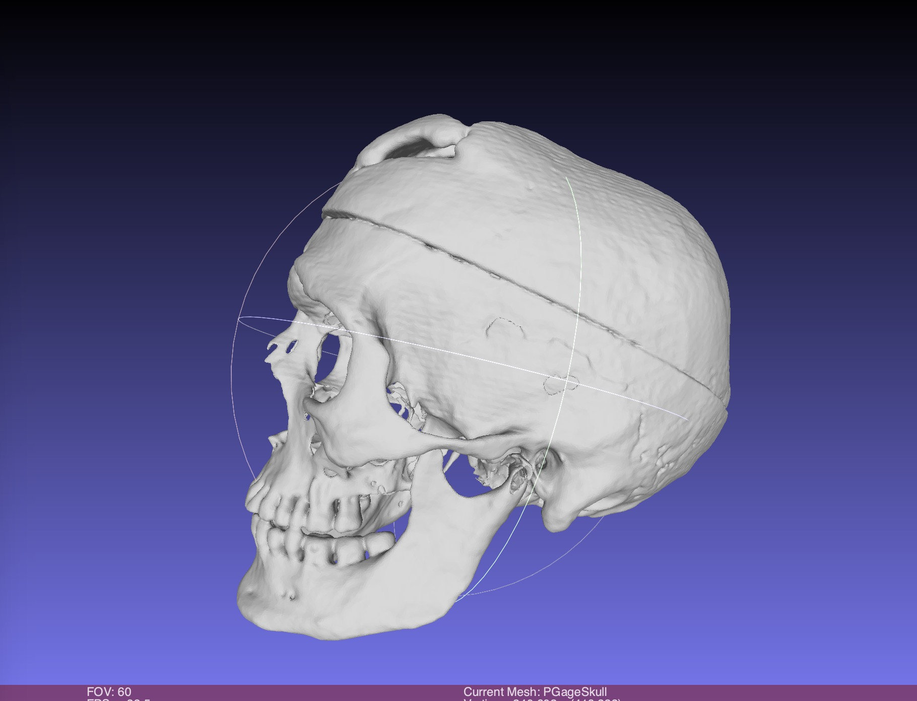 Phineas Gage Skull, harvard CT SCAN, Museum Quality High Resolution STL