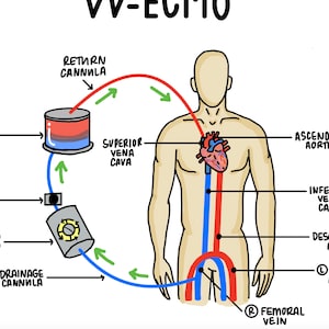 ECMO Circuits