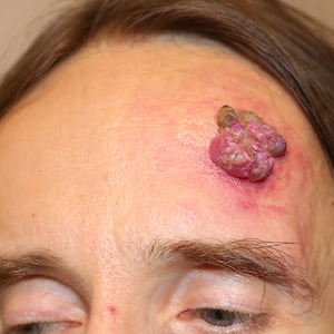 Gelatine Skin Cancer Wart. Prosthetic Appliance for Film and TV. Wart Special Effects and Prosthetics. SFX Make-Up. Halloween make-up.