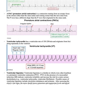 Pac Waveforms Strip Hurst NCLEX Review Notes | 75-page High-yield Study Guide (digital PDF ...