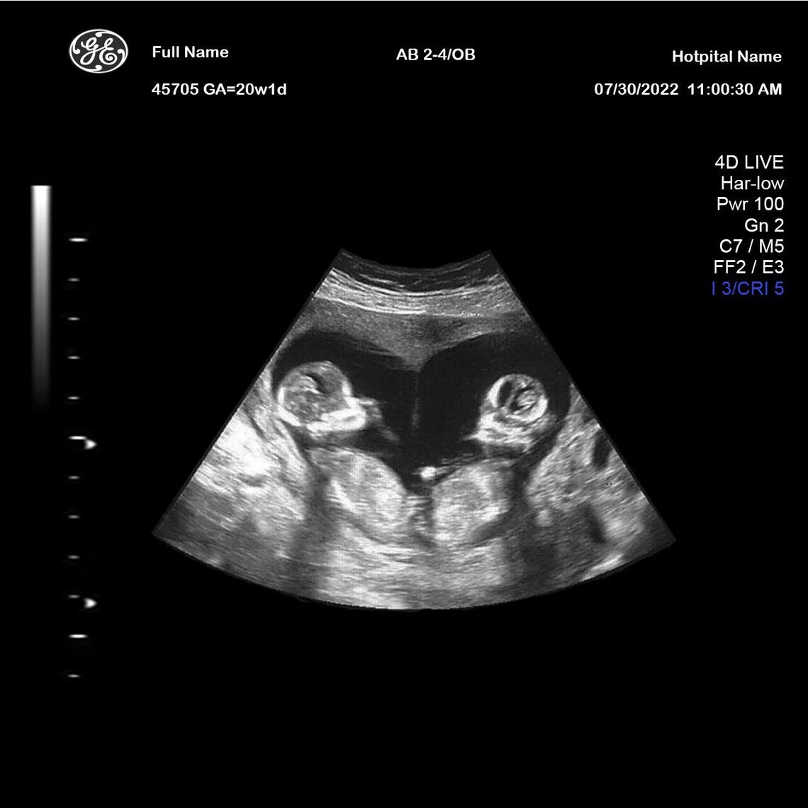 Prank 2D Fake Ultrasound Twin Babies at 20 Weeks Etsy