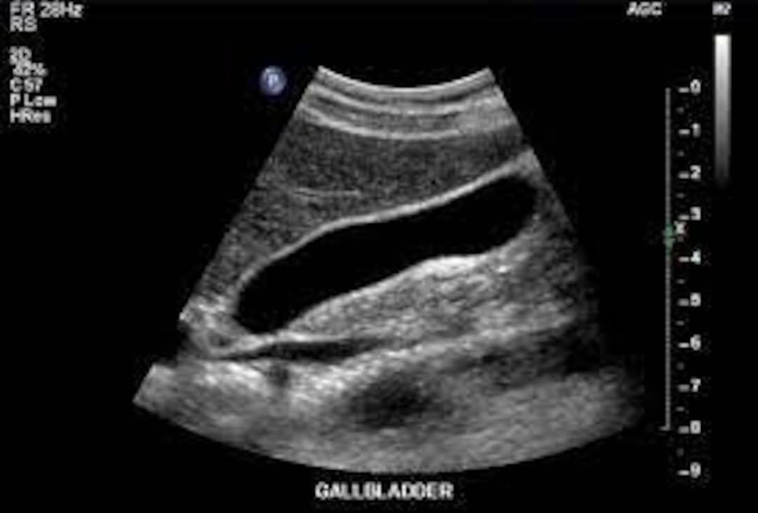 Pathology of the Gallbladder Ultrasound Etsy