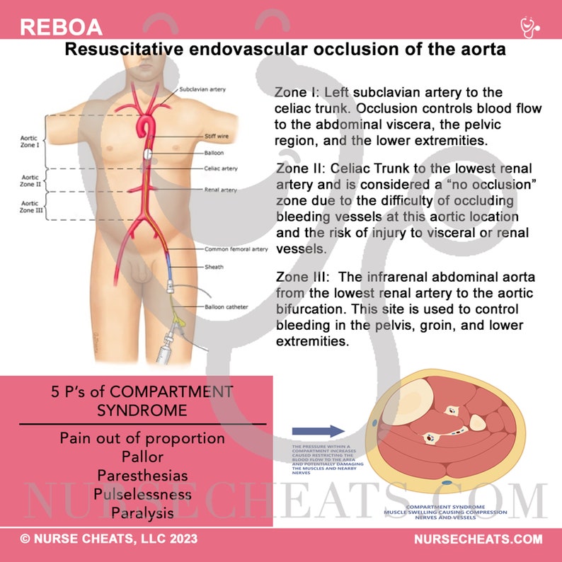 Side one of our REBOA badge buddy contains the zones of placement, documentation, and the 5 P's of compartment syndrome.