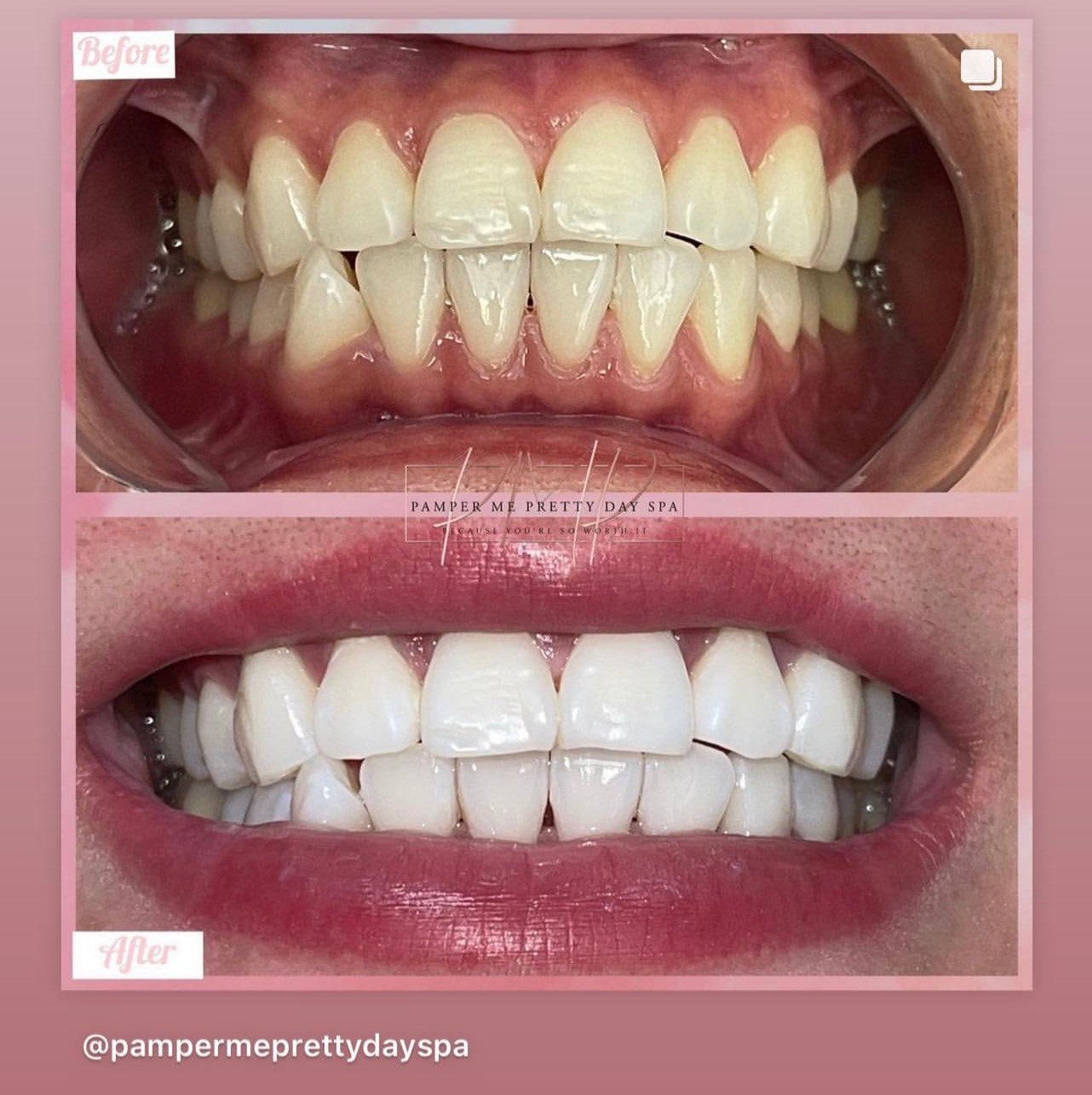 Five 44% Carbamide Peroxide Teeth Whitening Gel and Five Dental