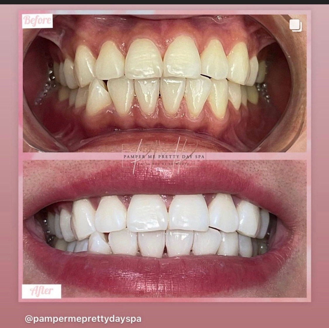 Teeth Whitening Kit, Professional Training, Teeth Whitening
