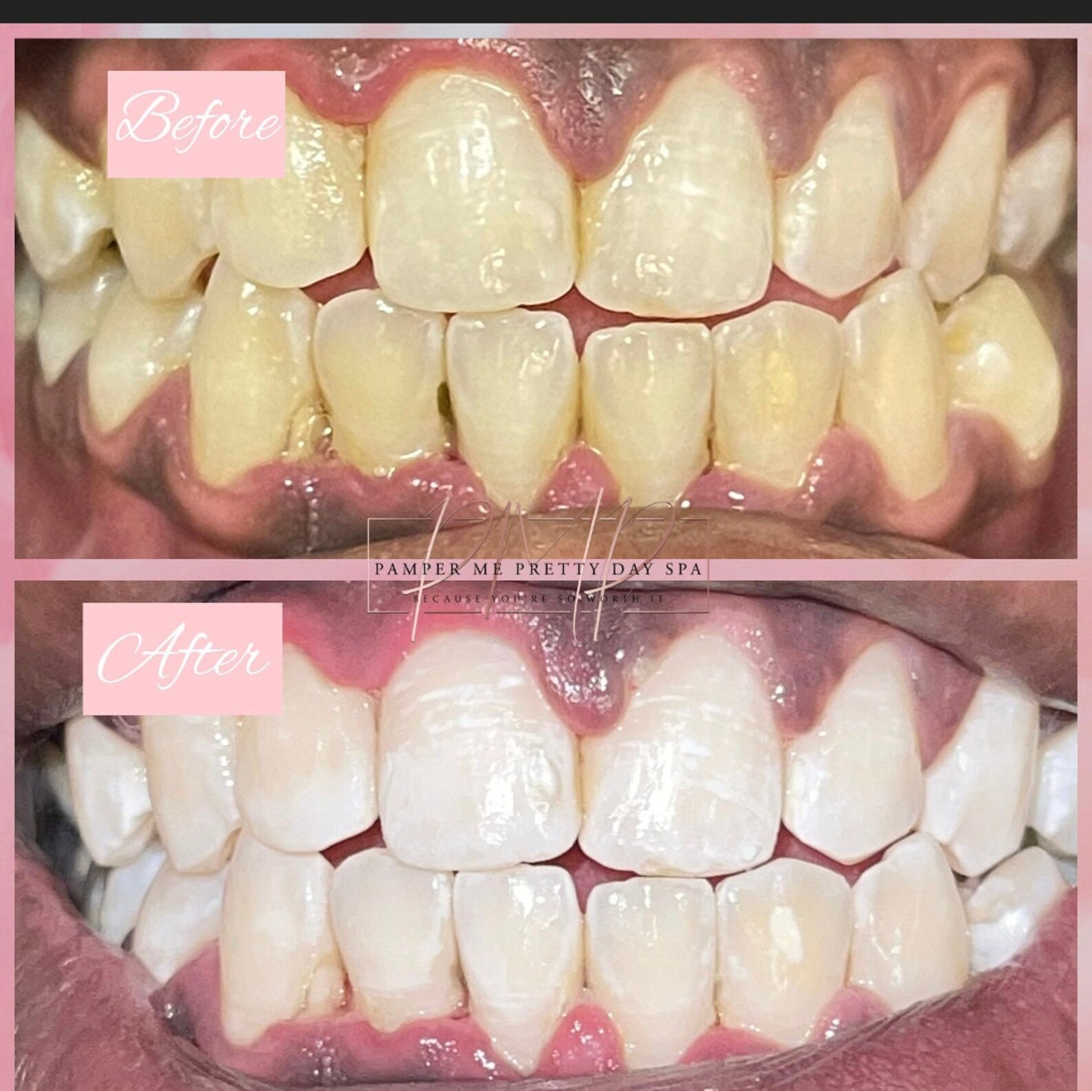 Teeth Whitening Kit, Professional Training, Teeth Whitening
