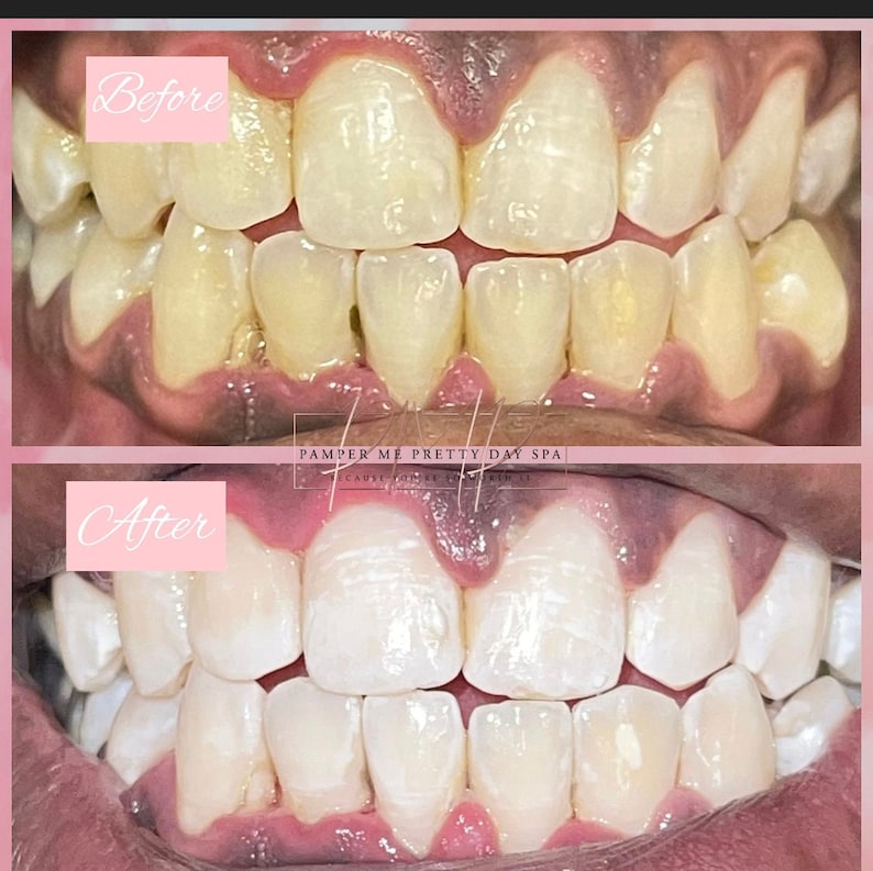 Teeth Whitening Kit, Professional Training, Teeth Whitening Certification, Teeth Whitening