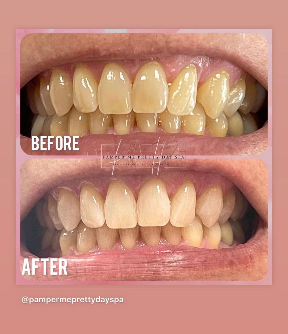 Teeth Whitening Kit Professional Training Teeth Whitening Etsy