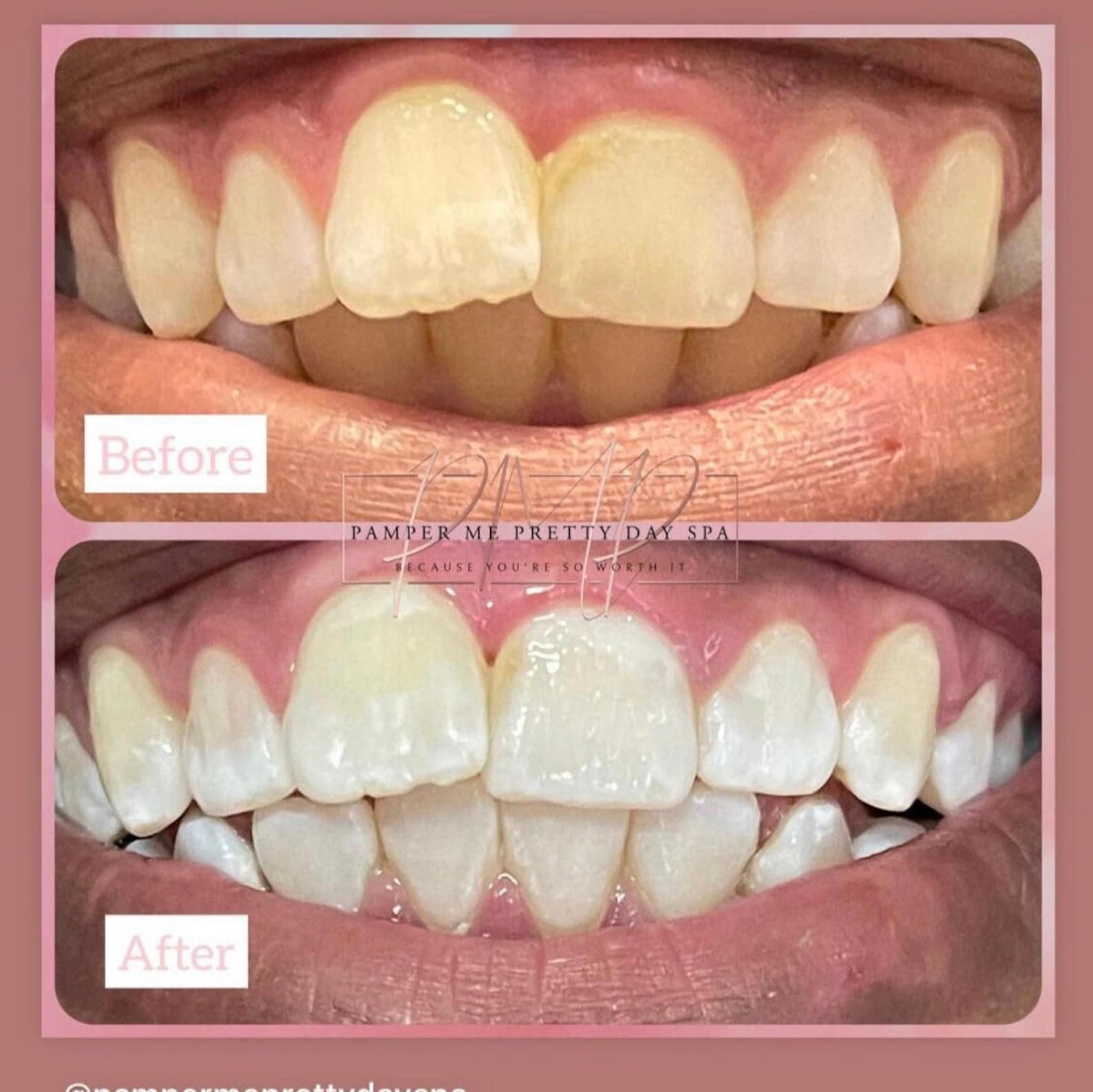 Teeth Whitening Kit Professional Training Teeth Whitening Etsy