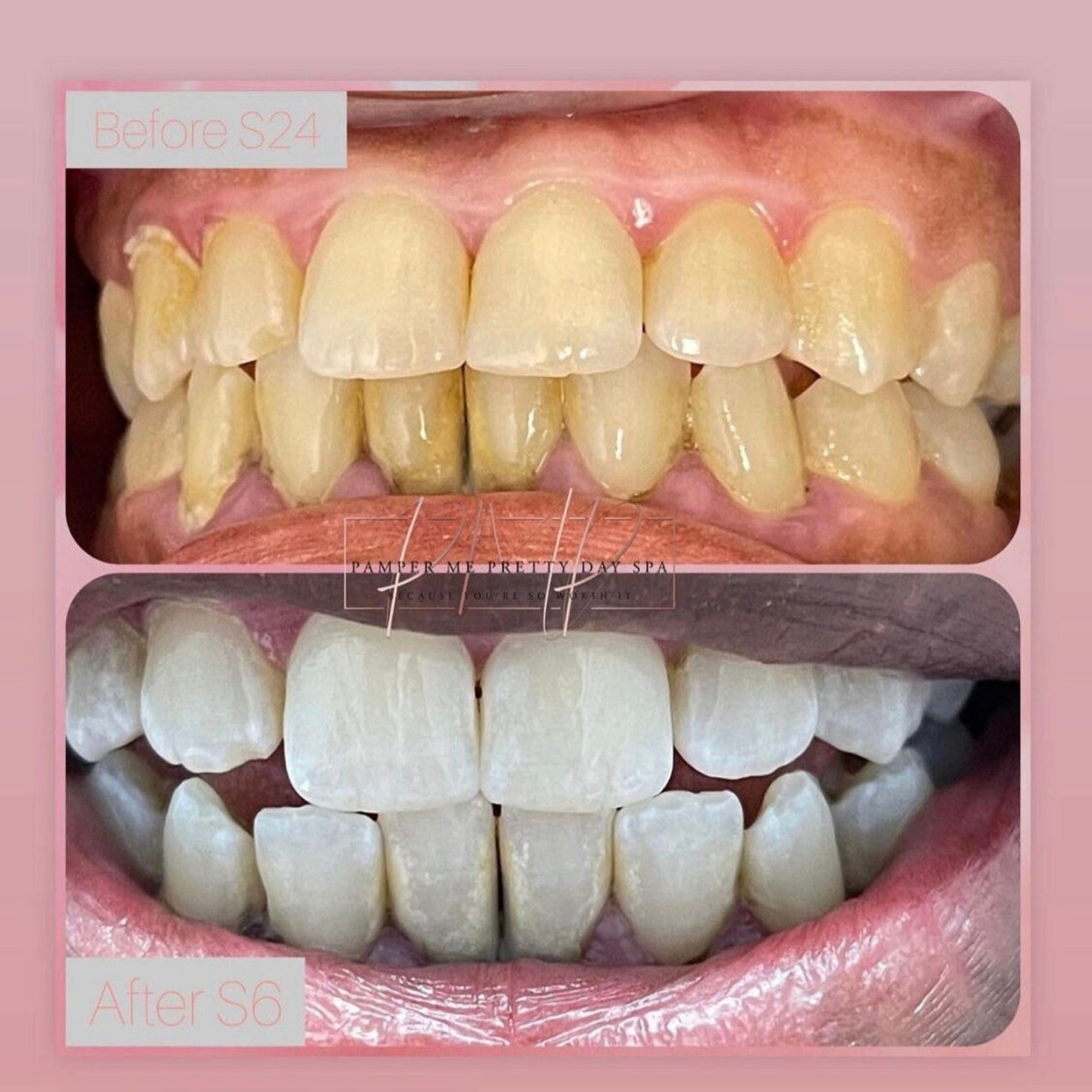 Teeth Whitening Kit, Professional Training, Teeth Whitening Certification, Teeth Whitening