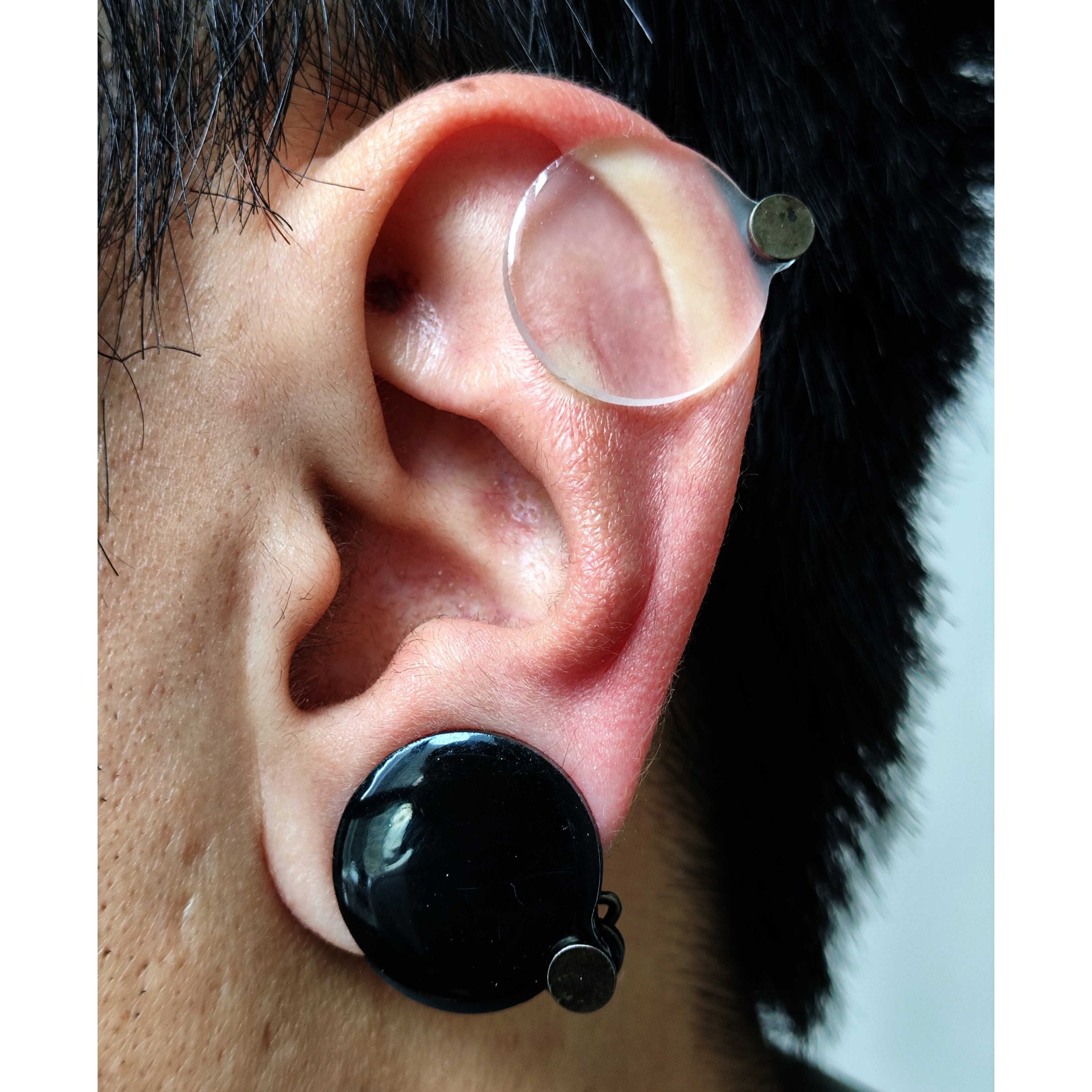 Ear keloid Custom Acrylic Compression - Pressure Earring, Made to Fit,  Flatten Keloid, Scar Management, Ear Scar Management