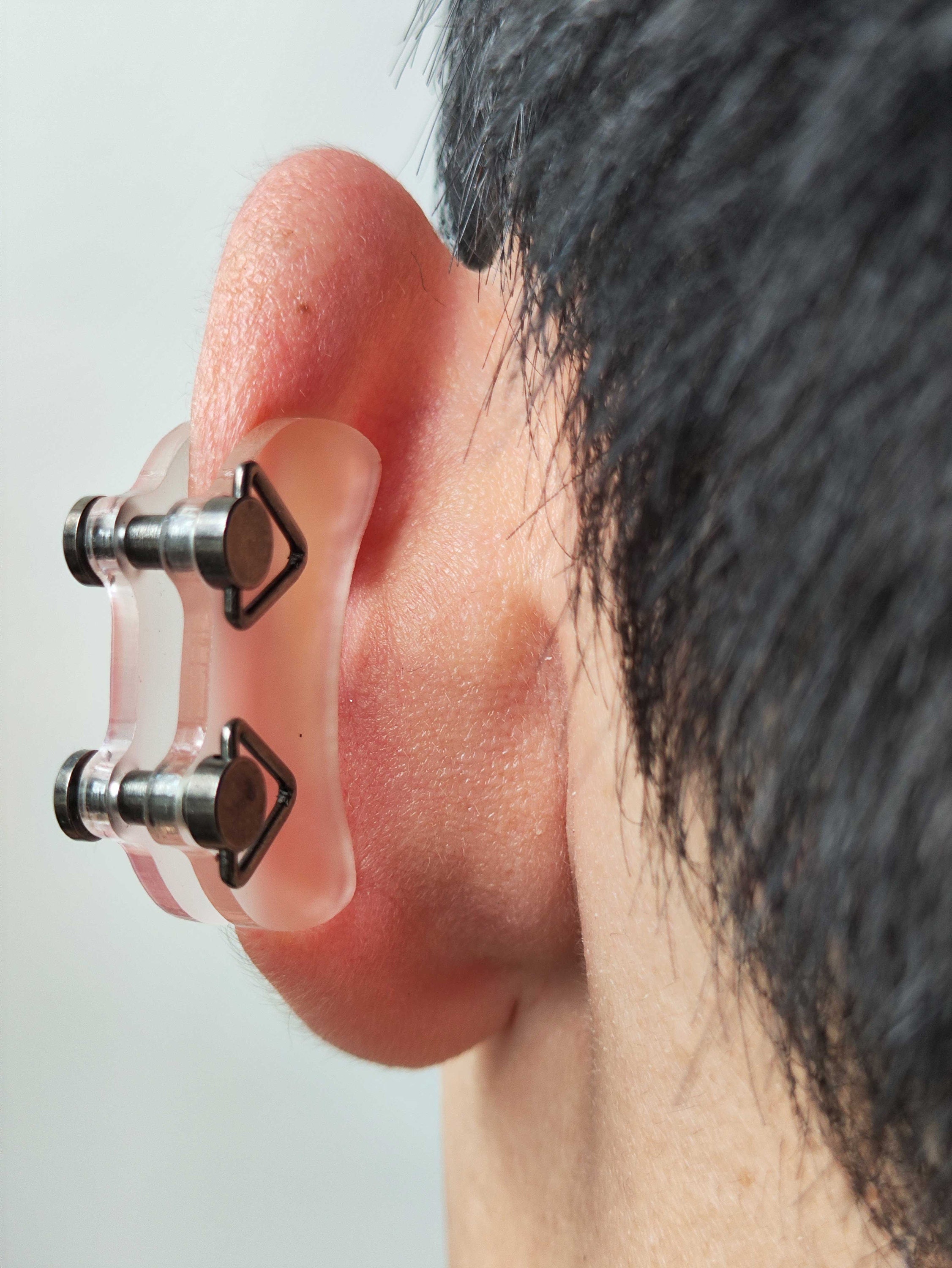 30x16mm 1.18x0.63 Keloid Pressure Earring Compression Jewelry Keloid