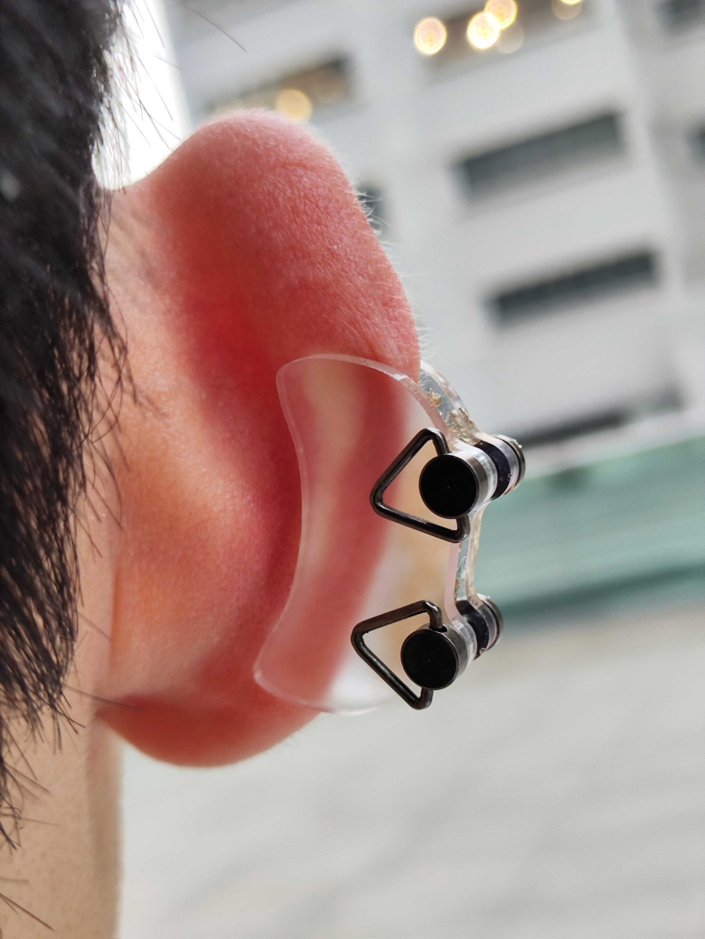 30x16mm 1.18x0.63 Keloid Pressure Earring Compression Jewelry Keloid