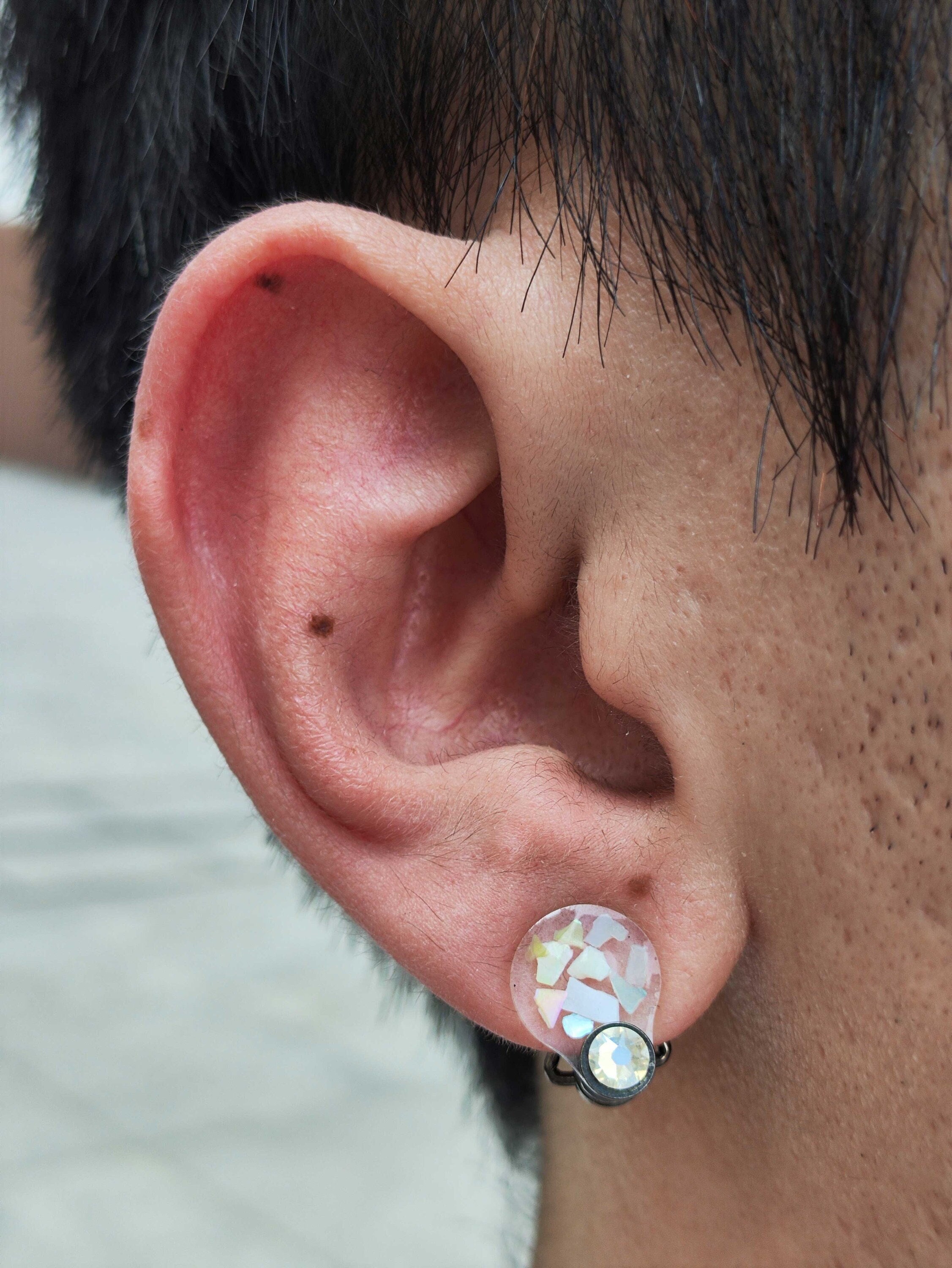 Ear keloid Custom Acrylic Compression - Pressure Earring, Made to Fit,  Flatten Keloid, Scar Management, Ear Scar Management