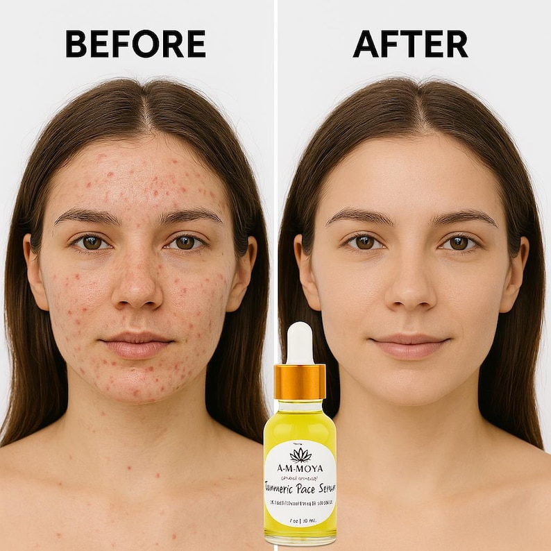 K&ouml;nnte beinhalten: Vorher-Nachher-Fotos eines Gesichts, die die Auswirkungen der Verwendung eines Kurkuma-Gesichts-Serums zeigen. Das Serum befindet sich in einer durchsichtigen Glasflasche mit goldener Kappe und einem Etikett mit der Aufschrift "A-M MOYA Turmeric Face Serum 1 fl oz | 30 ml".