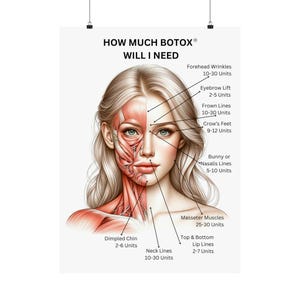 Botox Treatment Poster, How Much Botox Will I Need Female Facial Muscles, Nurse Injector Botox Consultation Board