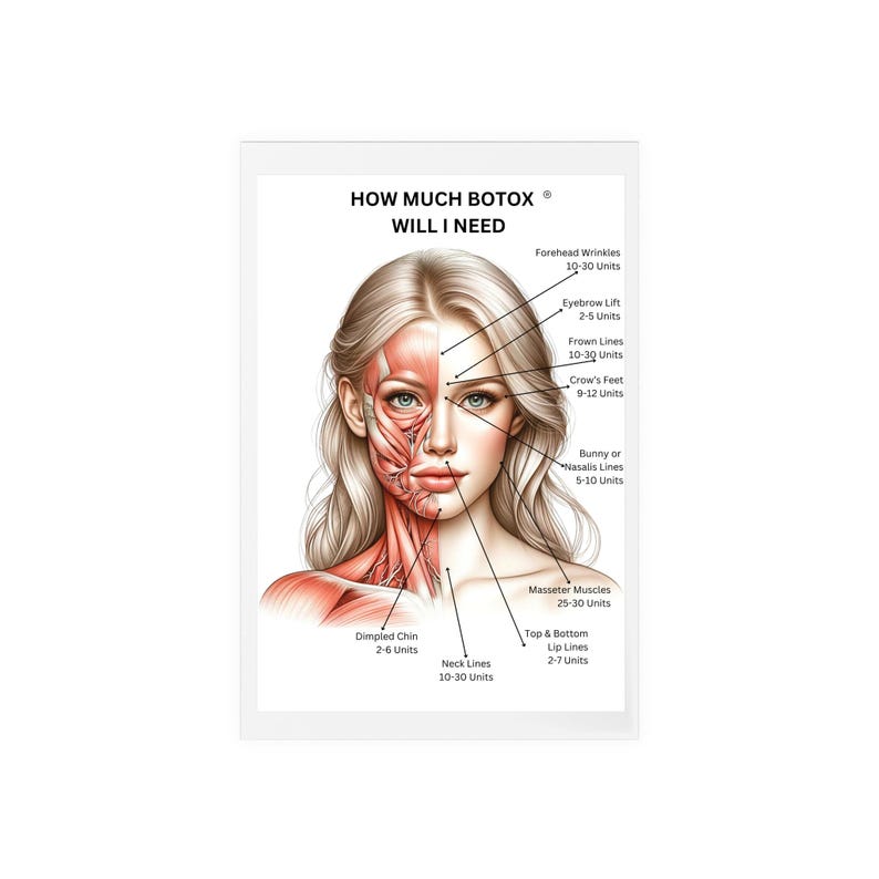 Botox Application Areas and Amount Acrylic Dry Erase Board, Cosmetic ...