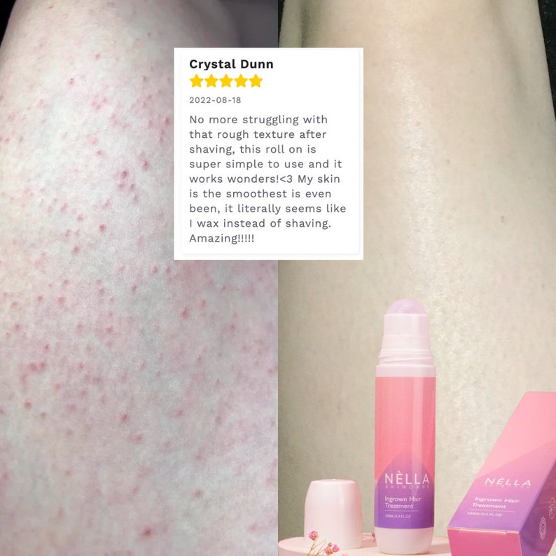 Ingrown Hair Oil Remover for Bikini, Intimate, Face After Shave Post