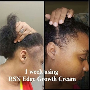 May include: Before and after photos showing the results of using RSN Edge Growth Cream. The image shows a person's hairline with visible hair growth after one week of using the product.
