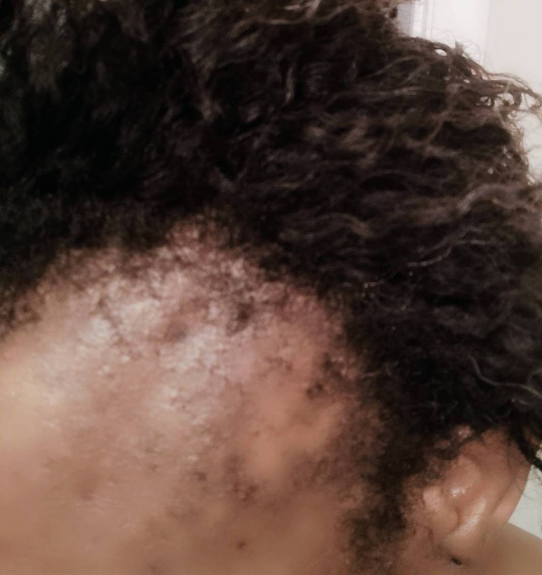 Cloves Supergrowth Hair Spray to Reverse Traction Alopecia Etsy