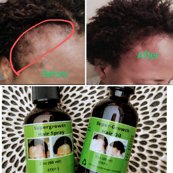 Cloves Super-growth hair spray  to reverse traction alopecia and severe hair damage (STEP 1)