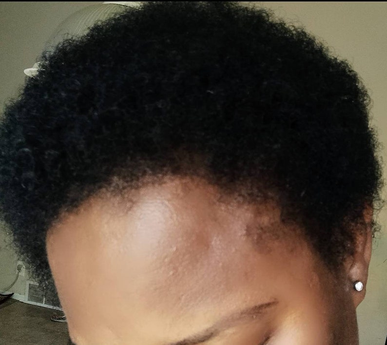 Cloves Supergrowth Hair Spray to Reverse Traction Alopecia Etsy